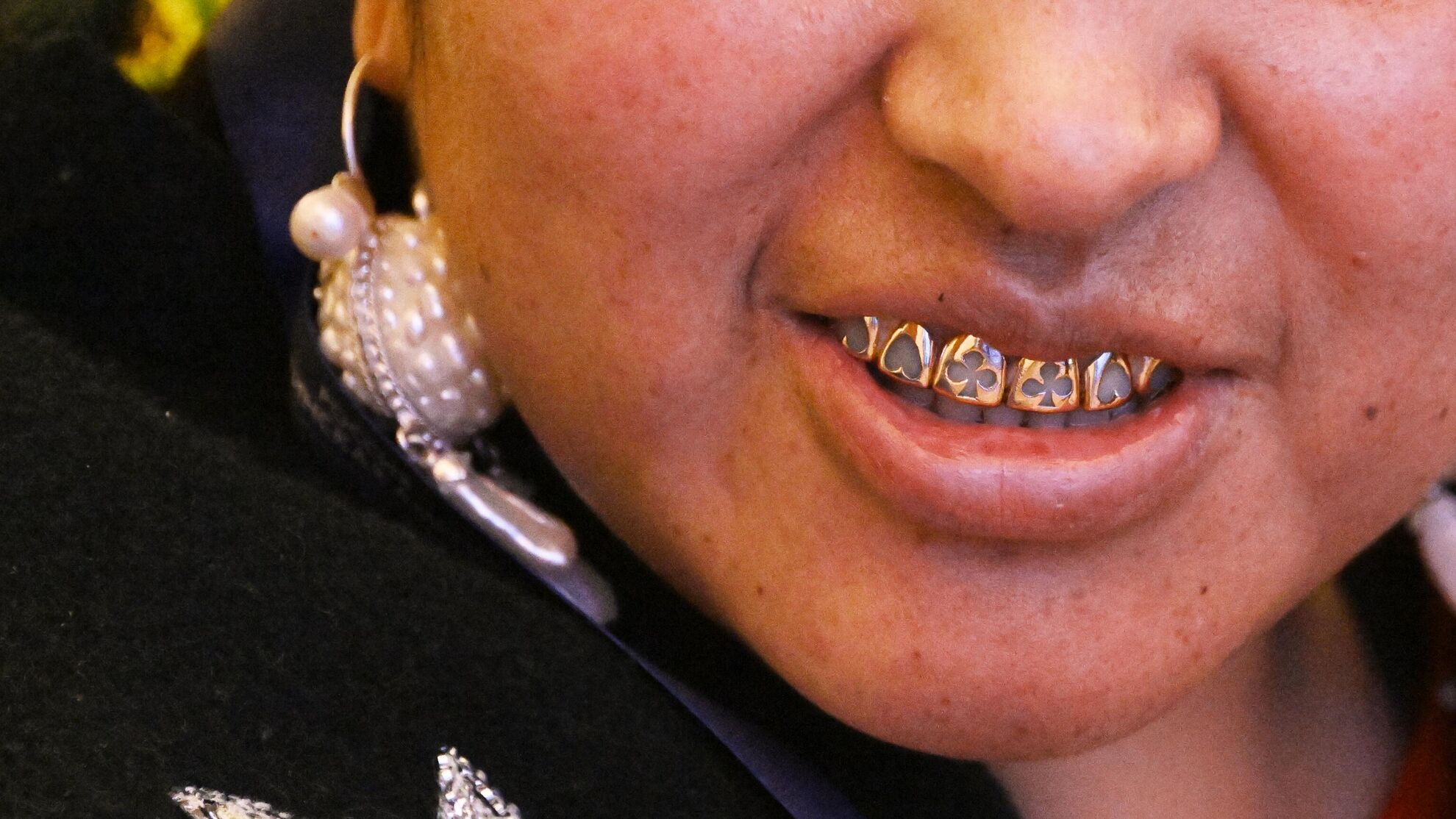 Безобидная шалость или опасная процедура? Стоматолог о бриллиантах в зубах - News-hub.ru, 27.12.2023